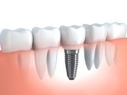 dental implant in London UK
