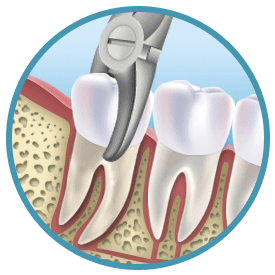 affordable-tooth-extractions in london uk hungarydentalimplant.co.uk