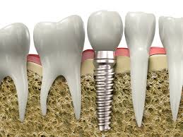 dental implant.jpg